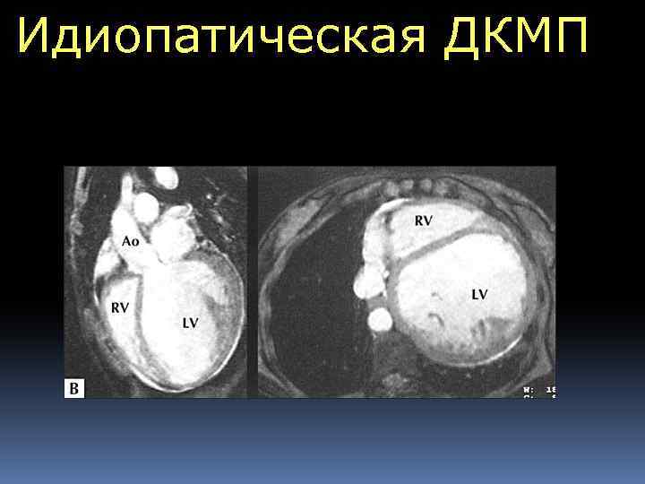 Идиопатическая ДКМП 