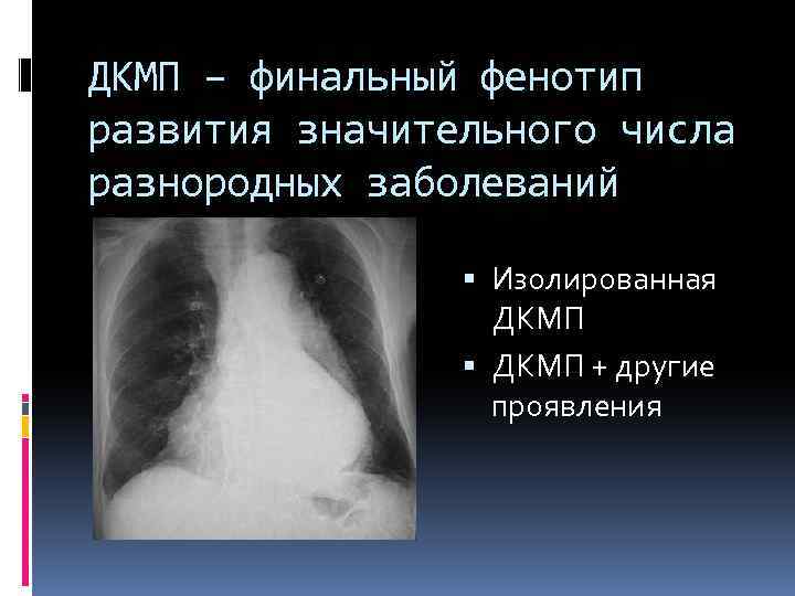 ДКМП – финальный фенотип развития значительного числа разнородных заболеваний Изолированная ДКМП + другие проявления