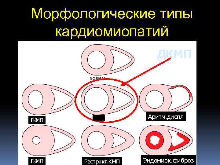 Морфологические типы кардиомиопатий ДКМП Аритм. диспл ГКМП Рестрикт. КМП Эндомиок. фиброз 