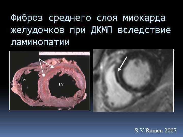 Фиброз среднего слоя миокарда желудочков при ДКМП вследствие ламинопатии S. V. Raman 2007 