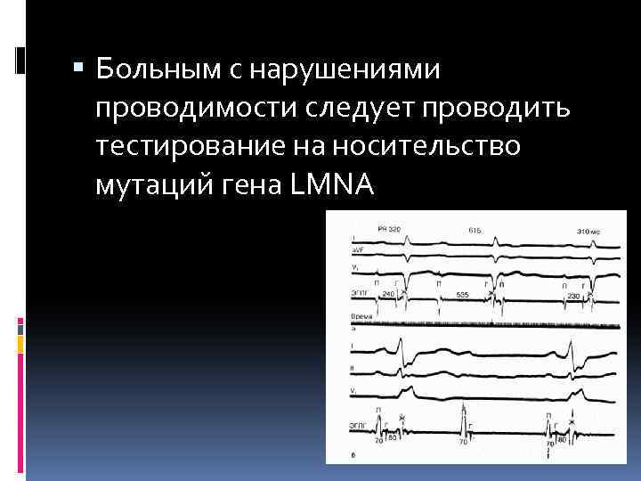  Больным с нарушениями проводимости следует проводить тестирование на носительство мутаций гена LMNA 