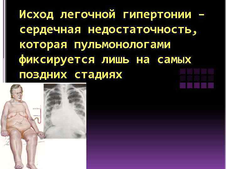 Исход легочной гипертонии – сердечная недостаточность, которая пульмонологами фиксируется лишь на самых поздних стадиях