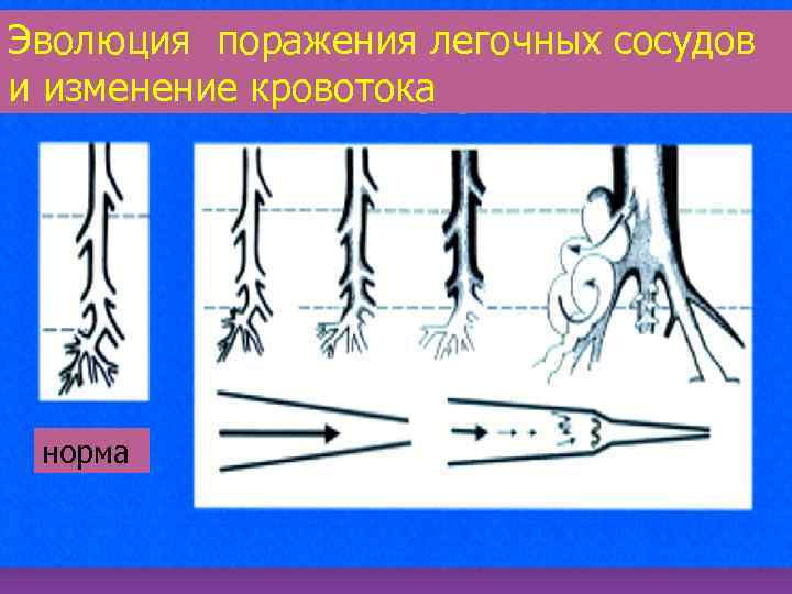 Эволюция поражения легочных сосудов и изменение кровотока норма 