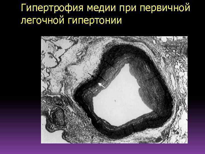 Гипертрофия медии при первичной легочной гипертонии 