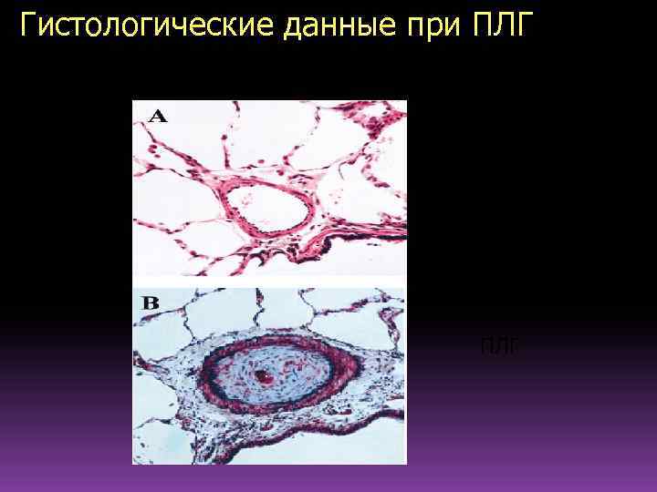 Гистологические данные при ПЛГ норма ПЛГ 