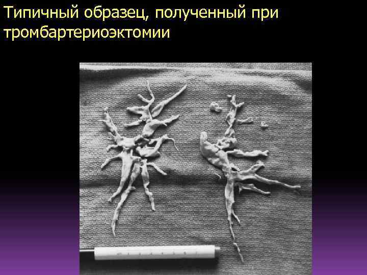 Типичный образец, полученный при тромбартериоэктомии 