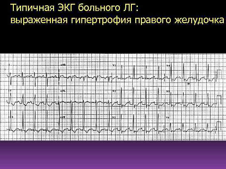 Типичная ЭКГ больного ЛГ: выраженная гипертрофия правого желудочка 