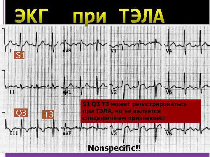 S 1 Q 3 T 3 может регистрироваться при ТЭЛА, но не является специфичным