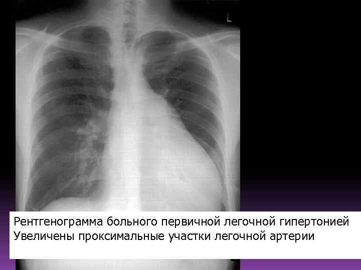 Рентгенограмма больного первичной легочной гипертонией Увеличены проксимальные участки легочной артерии 