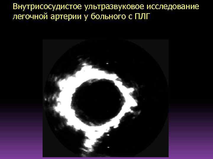 Внутрисосудистое ультразвуковое исследование легочной артерии у больного с ПЛГ 