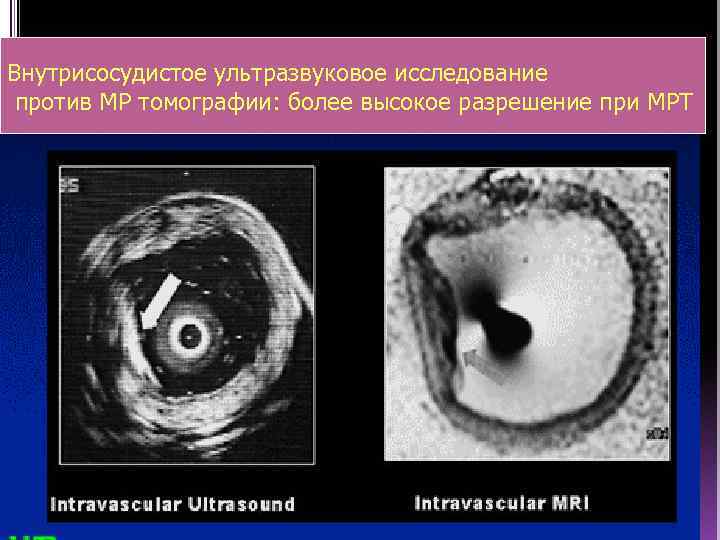 Внутрисосудистое ультразвуковое исследование против МР томографии: более высокое разрешение при МРТ 