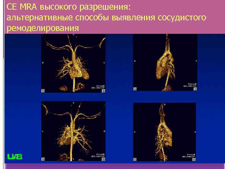 CE MRA высокого разрешения: альтернативные способы выявления сосудистого ремоделирования 