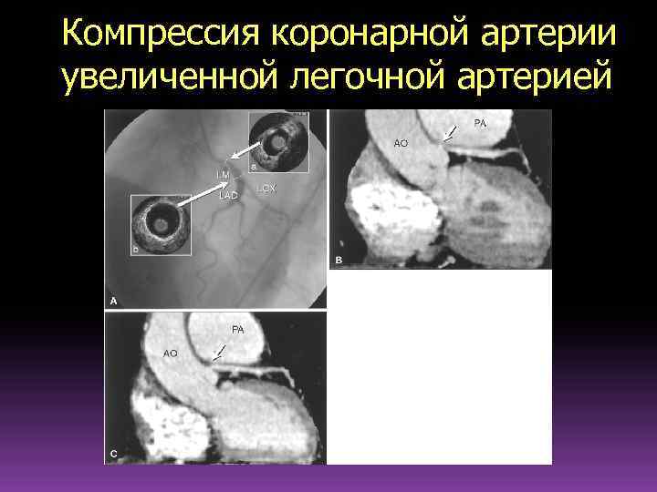 Компрессия коронарной артерии увеличенной легочной артерией 