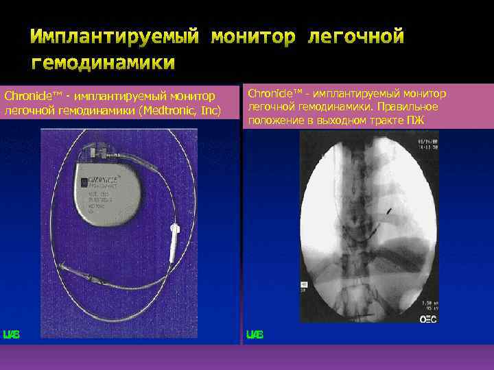 Chronicle™ - имплантируемый монитор легочной гемодинамики (Medtronic, Inc) Chronicle™ - имплантируемый монитор легочной гемодинамики.
