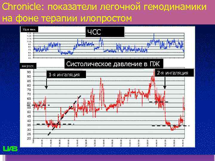 Chronicle: показатели легочной гемодинамики на фоне терапии илопростом ЧСС Уд. в мин. мм рт.