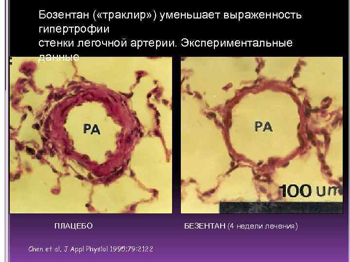 Бозентан ( «траклир» ) уменьшает выраженность гипертрофии стенки легочной артерии. Экспериментальные данные ПЛАЦЕБО Chen