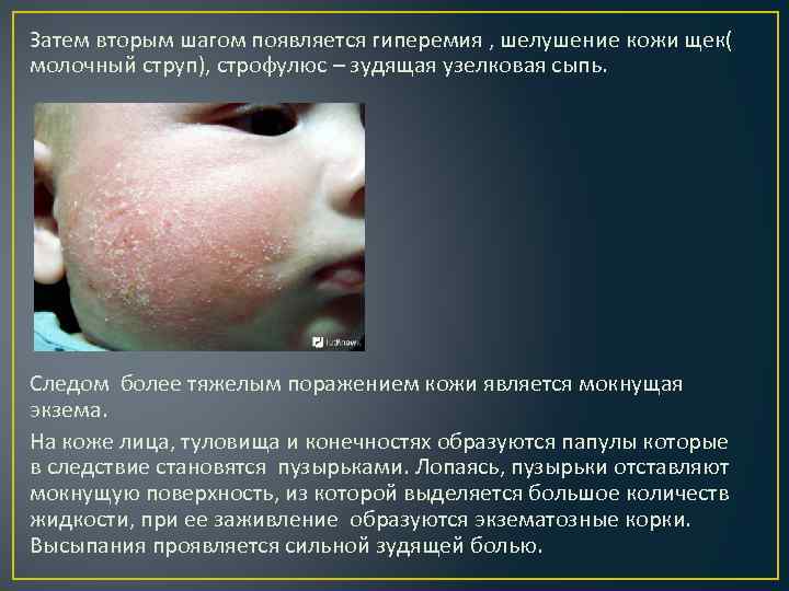 Затем вторым шагом появляется гиперемия , шелушение кожи щек( молочный струп), строфулюс – зудящая