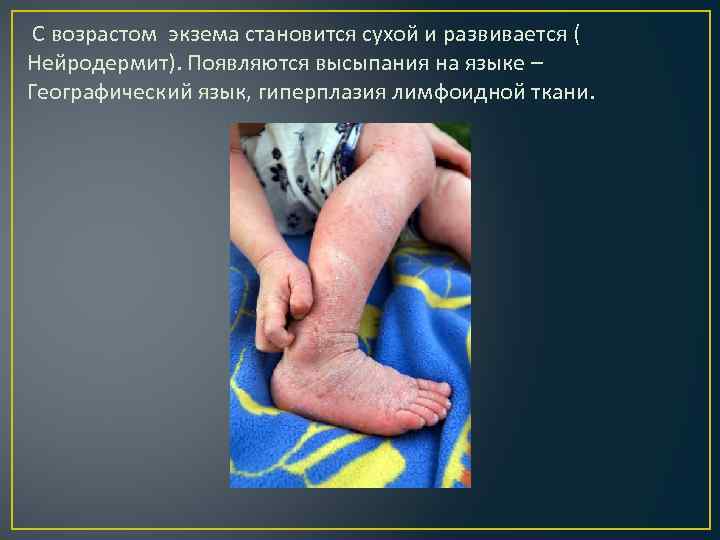  С возрастом экзема становится сухой и развивается ( Нейродермит). Появляются высыпания на языке