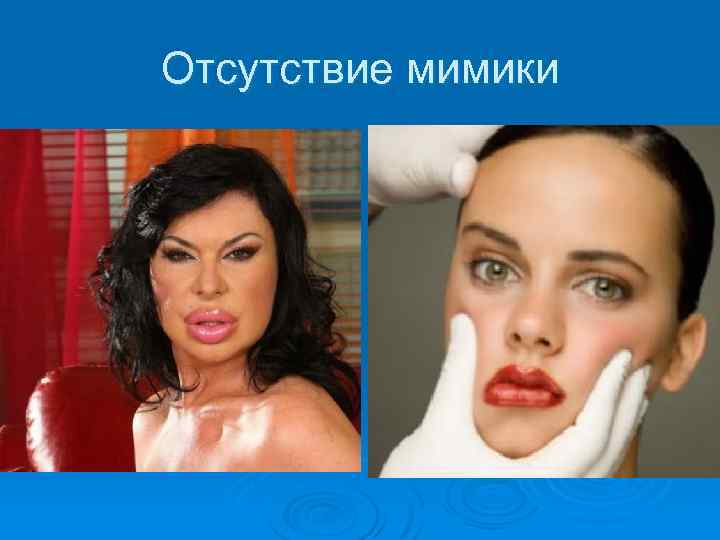 Отсутствие мимики 