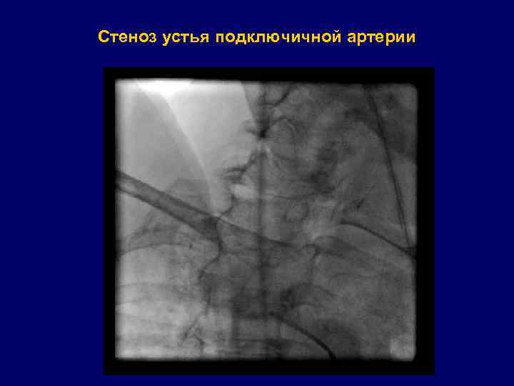 Стеноз устья подключичной артерии 