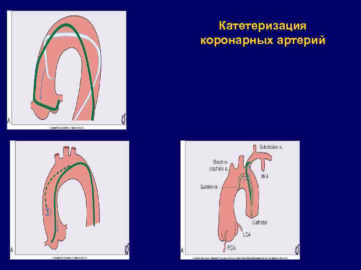 Катетеризация коронарных артерий 