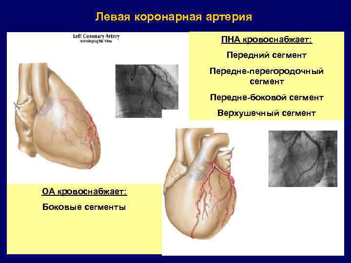 Левая коронарная артерия ПНА кровоснабжает: Передний сегмент Передне-перегородочный сегмент Передне-боковой сегмент Верхушечный сегмент ОА