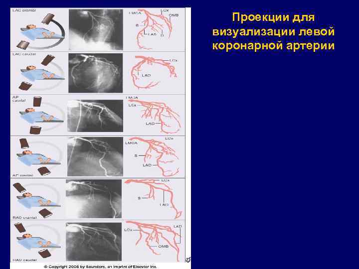 Проекции для визуализации левой коронарной артерии 