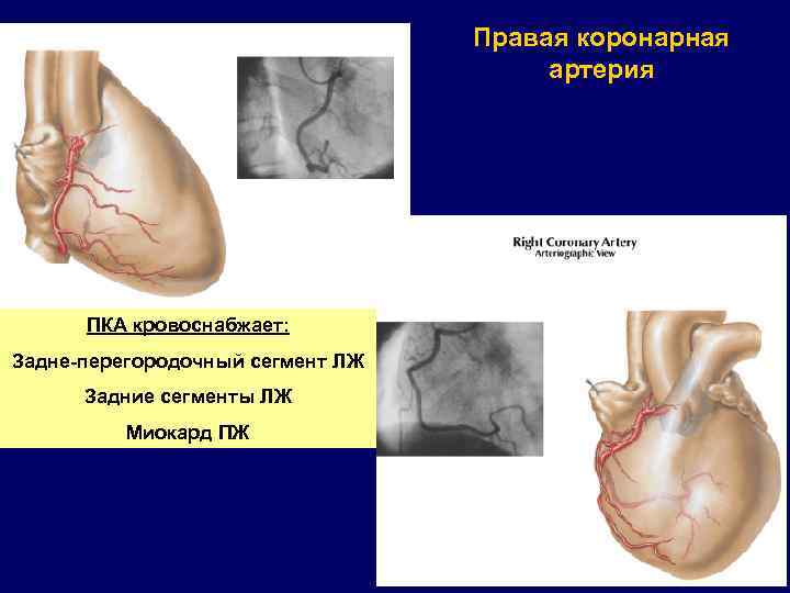 Правая коронарная артерия ПКА кровоснабжает: Задне-перегородочный сегмент ЛЖ Задние сегменты ЛЖ Миокард ПЖ 