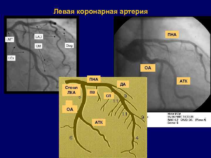 Пна. Рентгенанатомия коронарных артерий. Коронарные сосуды рентгенанатомия. ПНА коронарная артерия. ПНА сосуд это.