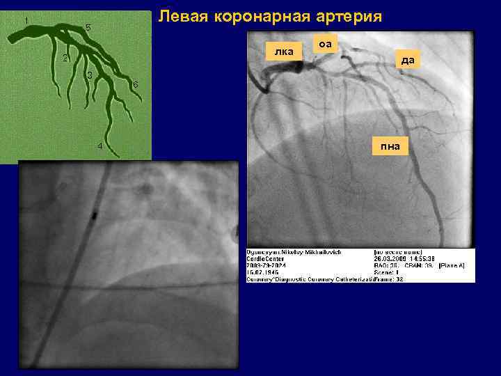 Левая коронарная артерия лка оа да пна 