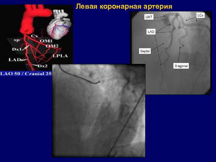 Левая коронарная артерия 