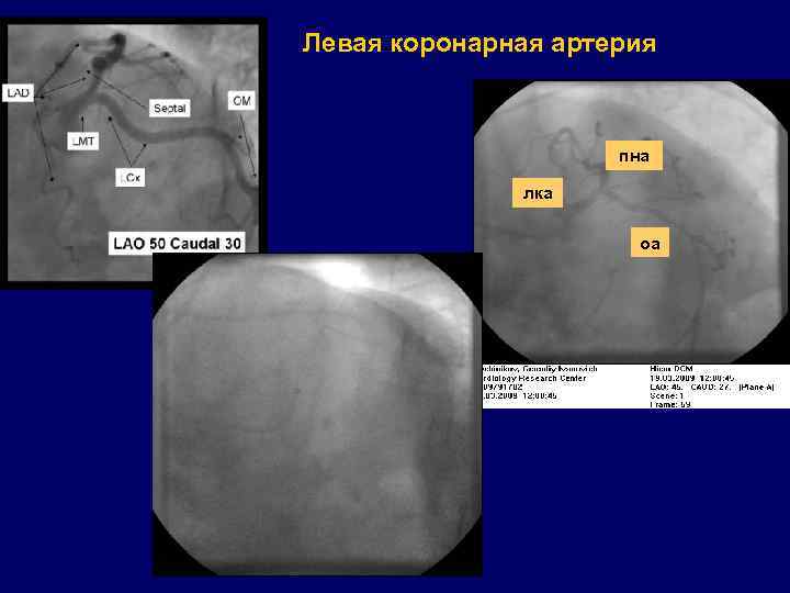 Левая коронарная артерия пна лка оа 