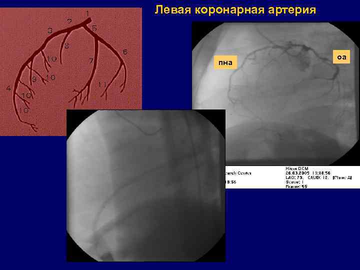 Левая коронарная артерия пна оа 