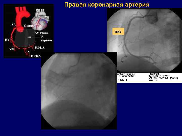 Правая коронарная артерия пка 