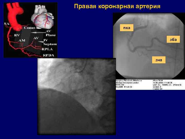 Правая коронарная артерия пка зба зна 