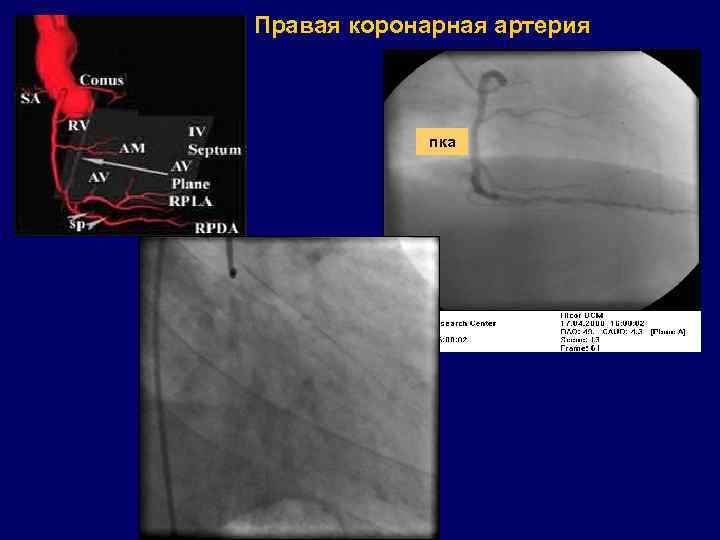 Правая коронарная артерия пка 