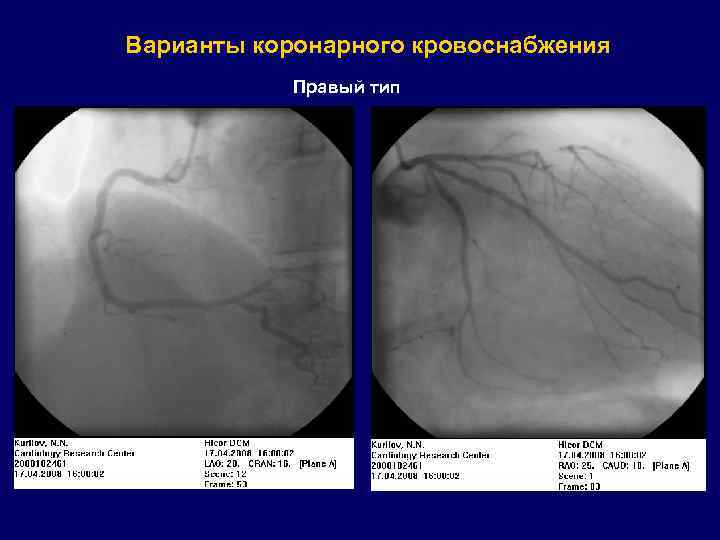 Варианты коронарного кровоснабжения Правый тип 