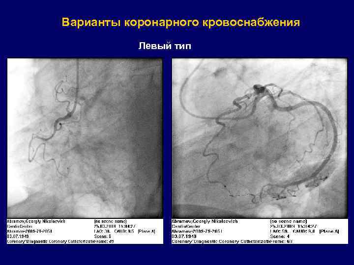 Варианты коронарного кровоснабжения Левый тип 
