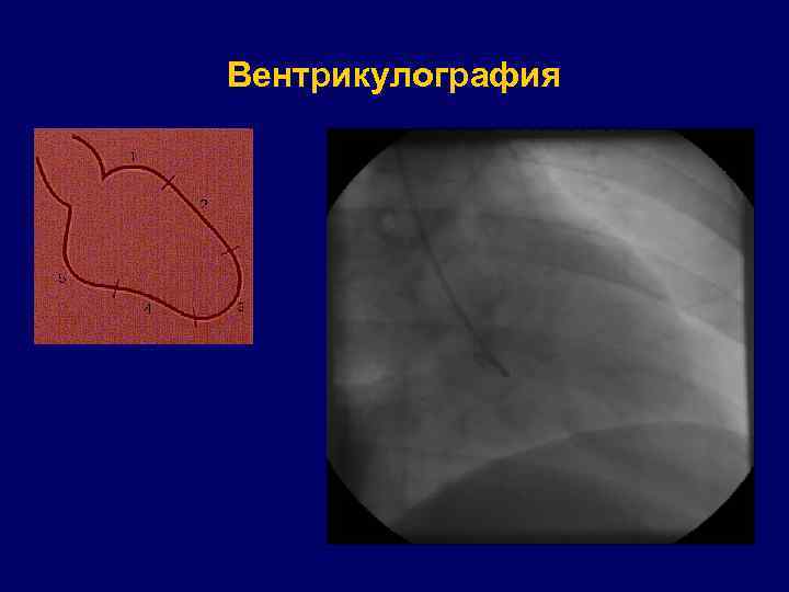 Вентрикулография 