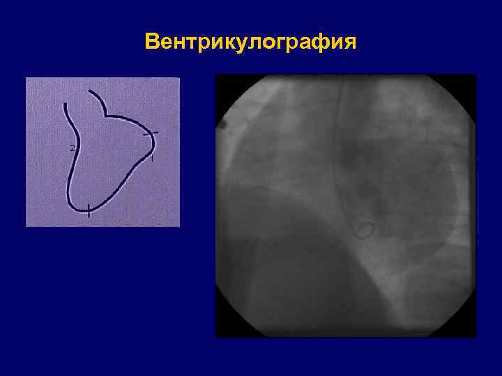 Вентрикулография 