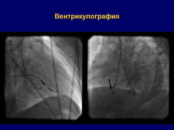 Вентрикулография 
