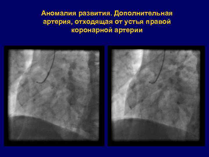 Аномалия развития. Дополнительная артерия, отходящая от устья правой коронарной артерии 