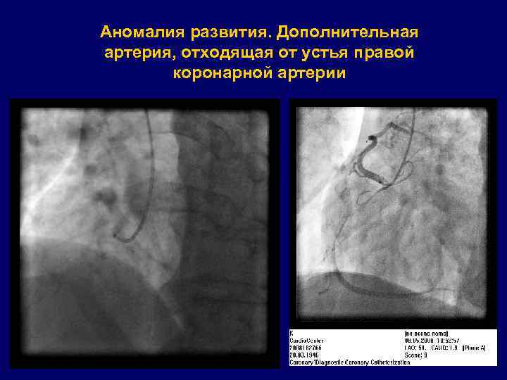 Аномалия развития. Дополнительная артерия, отходящая от устья правой коронарной артерии 