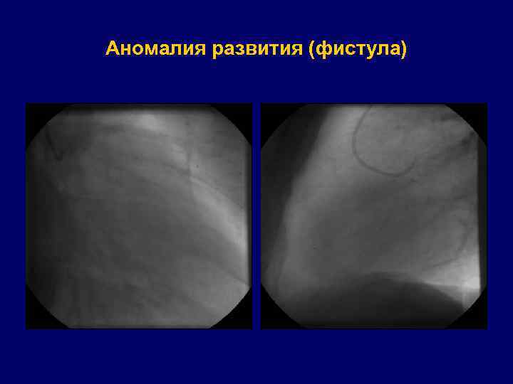 Аномалия развития (фистула) 