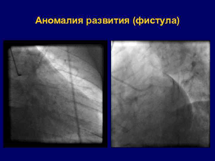 Аномалия развития (фистула) 