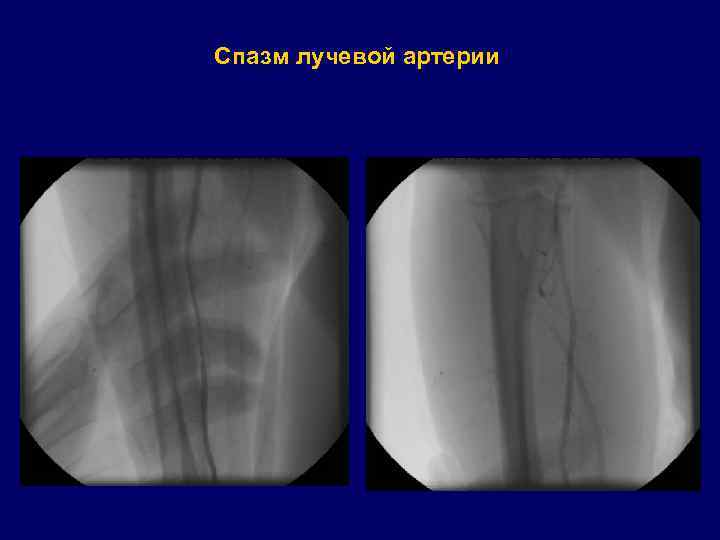 Спазм лучевой артерии 