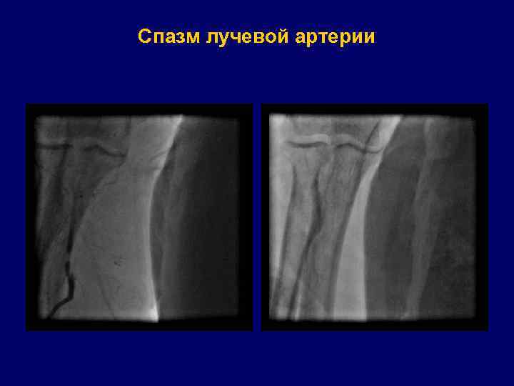 Спазм лучевой артерии 