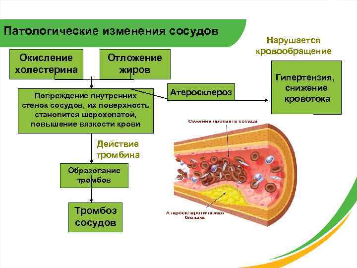 Патологические изменения сосудов Окисление холестерина Отложение жиров Повреждение внутренних стенок сосудов, их поверхность становится