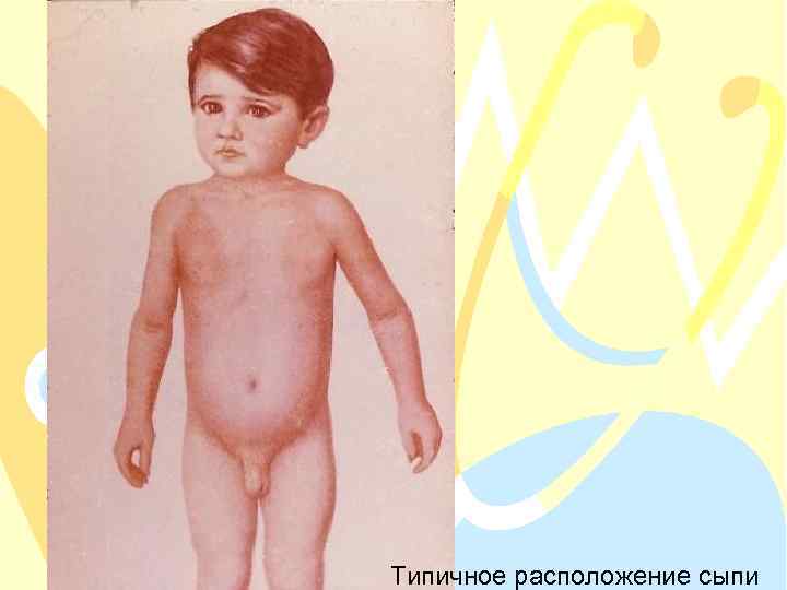 Типичное расположение сыпи 