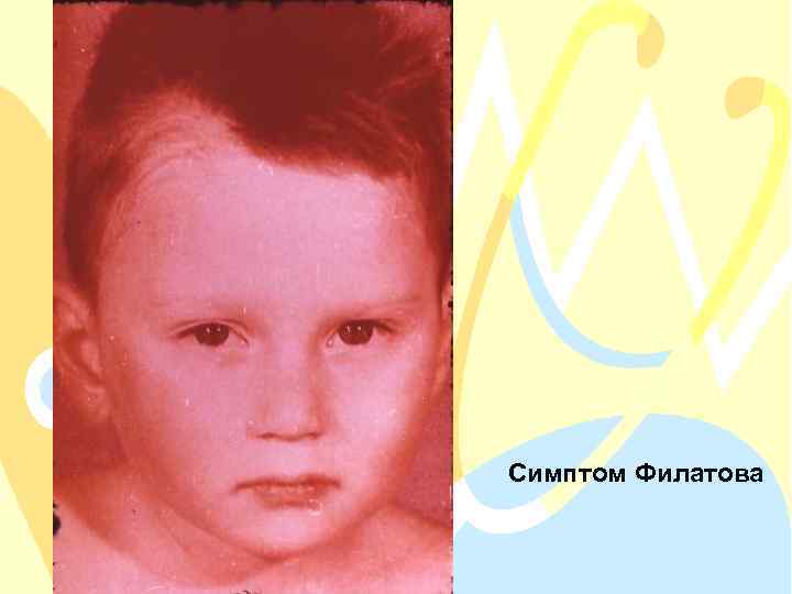 Симптом Филатова 